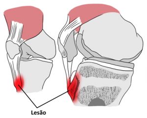 Osteocondrite Causas Sintomas E Tratamento