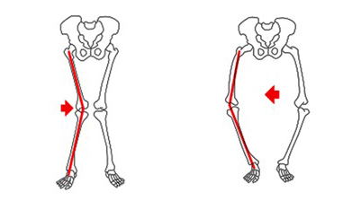 Ilustração dos tipos de joelho que podem estar relacionados aos tipos de pisada