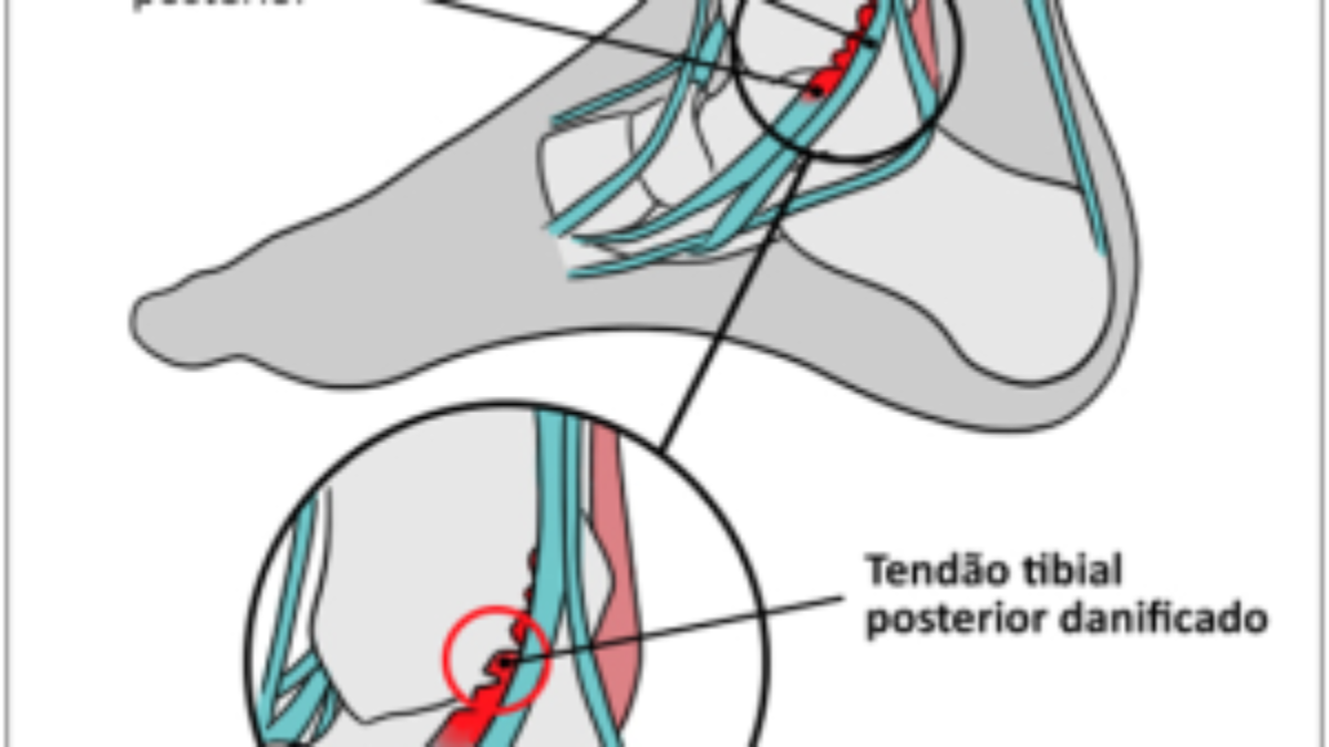 Como desinflamar o nervo tibial?