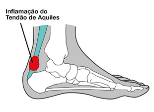 tendinite-no-tendao-de-aquiles