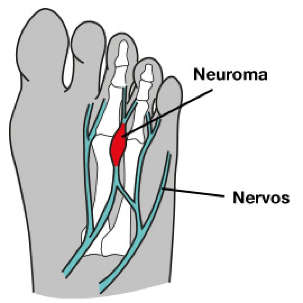 Dor no pé pode estar relacionada ao neuroma de morton