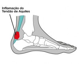 O calcanhar de Aquiles: da história à vida real